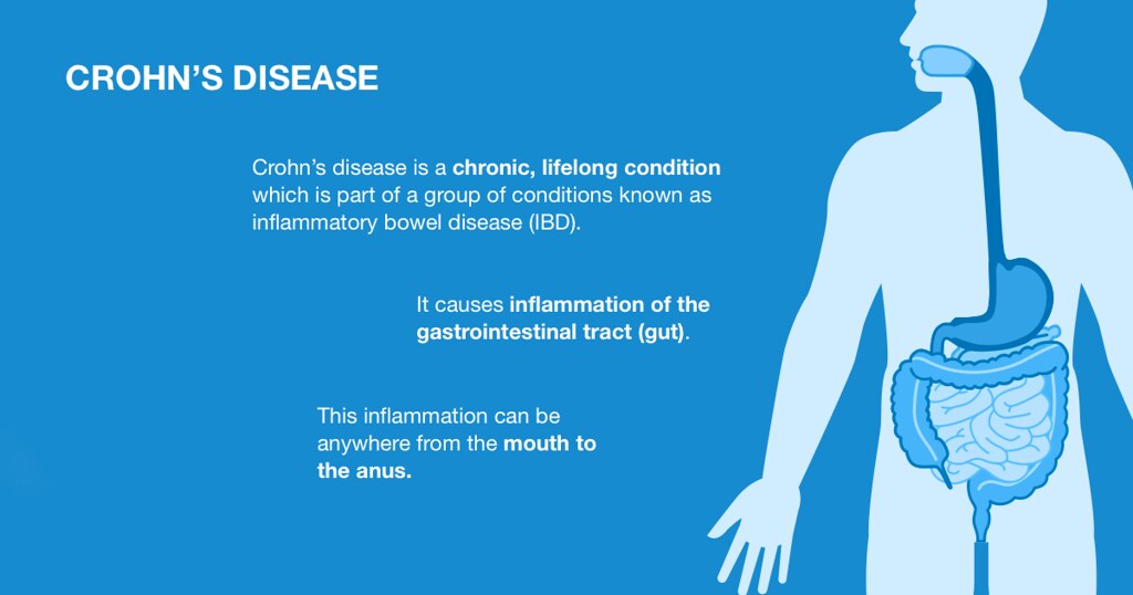 crohn's disease what is it